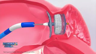 Download lagu Kembali Bersemangat: Jimat untuk AFib mp3