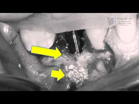 Stabile Zahnimplantate dank „kleinem Knochenaufbau“