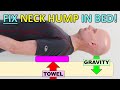 Best SYSTEM To Fix Neck Hump, Forward Head Posture & Hunchback IN BED!