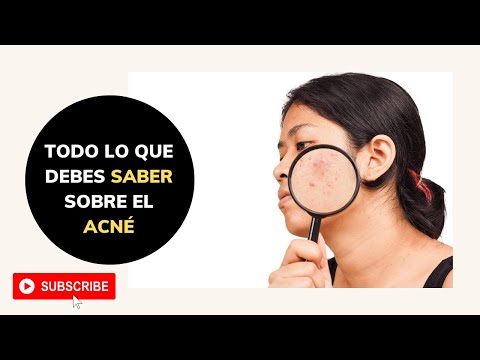 TODO lo que debes saber del ACNÉ