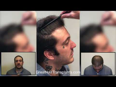 Dr. Brett Bolton Patient Rod 9 Year Follow Up Video
