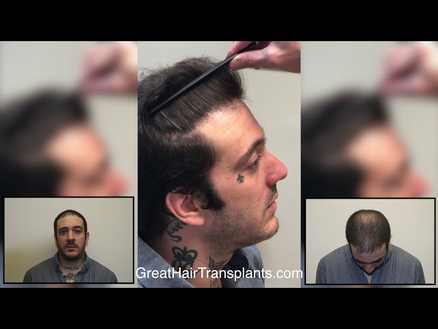 Dr. Brett Bolton Patient Rod 9 Year Follow Up Video
