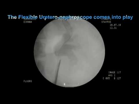 UreteroNephro-Lithotripsy Part 2