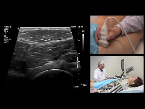 Groin pain and ultrasound - part 5 - Rectus femoris muscle