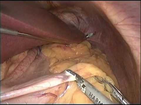 EndoLift for Liver Retraction During Sleeve Gastrectomy