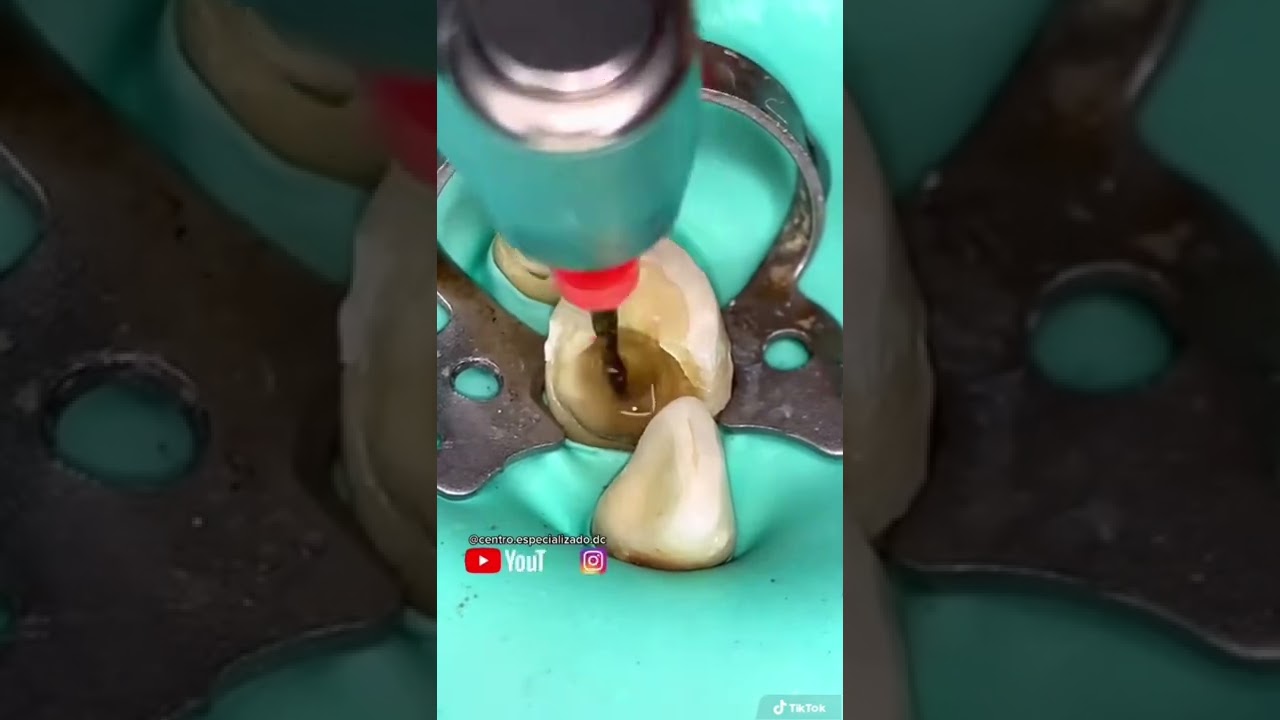 Watch ¡Le mataron el nervio al diente! Now ¡Le mataron el nervio al diente!