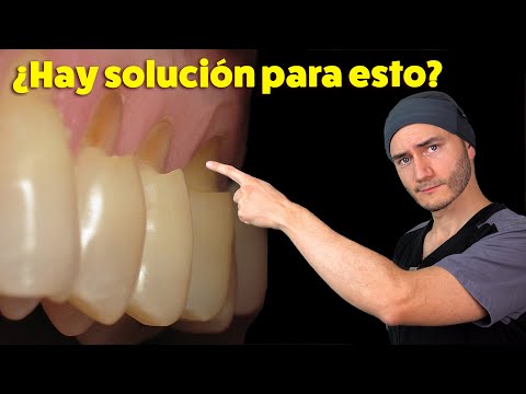 Dentista Te Explica El Desgaste En El Cuello De Los Dientes