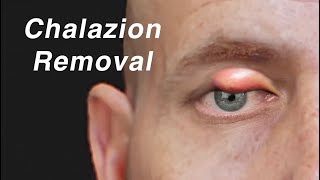 Chalazion (Eyelid Cyst) Removal Animation
