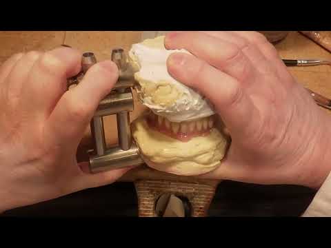 Eine kleine Über-Nacht-Unterfütterung – So sitzt die Prothese wieder perfekt!