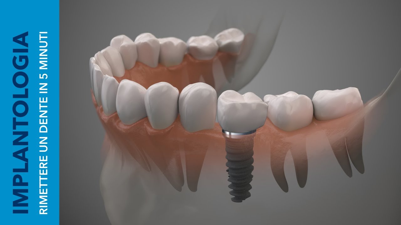 Watch Now IMPIANTO SINGOLO | Come rimettere un Dente in circa 5 Minuti IMPIANTO SINGOLO | Come rimettere un Dente in circa 5 Minuti