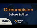 Before V S After Laser Circumcision Surgery For FREE Consultation Call On 08065417725
