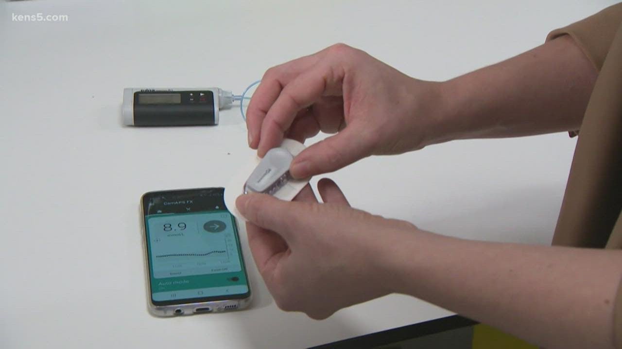 Artificial pancreas could help control blood sugar levels in young kids with Type 1 diabetes
