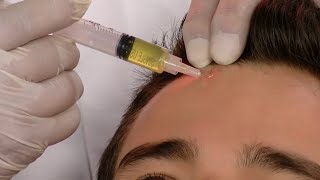 Como Evitar la Caida del Cabello Aplicando Plaquetas de Plasma Capilar  por Juan Gonzalo Angel