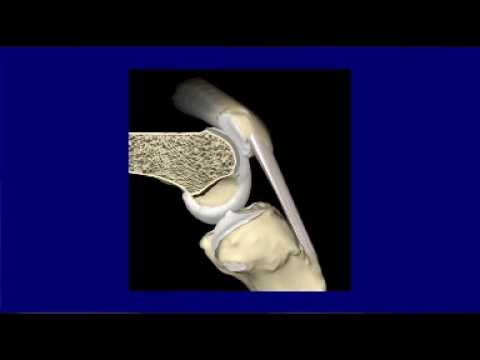 Öv a csípőízület artrózisához
