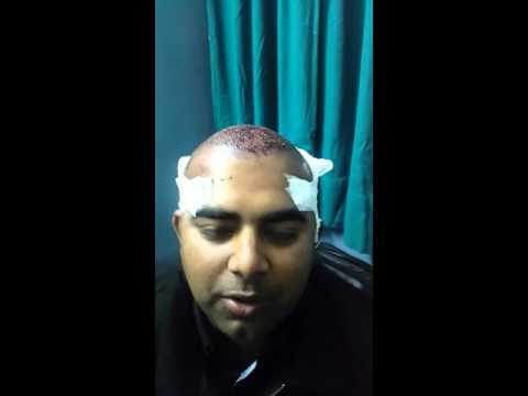 Men Hair Transplants