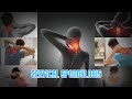 Cervical Spondylosis
