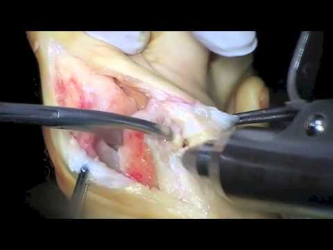 Tratamentul bursitei calcaroase a articulației șoldului