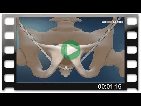 DynaMesh®-SIS visible Animation: Surgical Treatment of Urinary Stress Incontinence - TOT inside-out