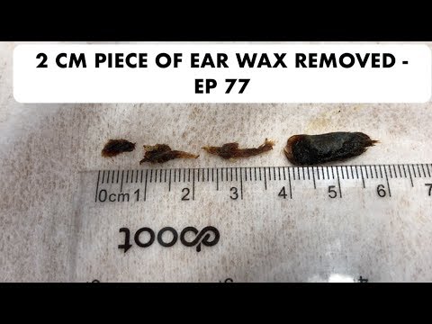 2 CM PIECE OF EAR WAX REMOVED - EP 77