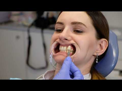 Отбеливания зубов в одно посещение.