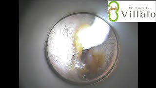 耳掃除動画vol.37「vol.7のお客様 3回目のご来店」