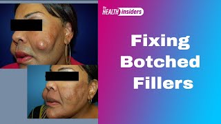 Fixing Botched Fillers