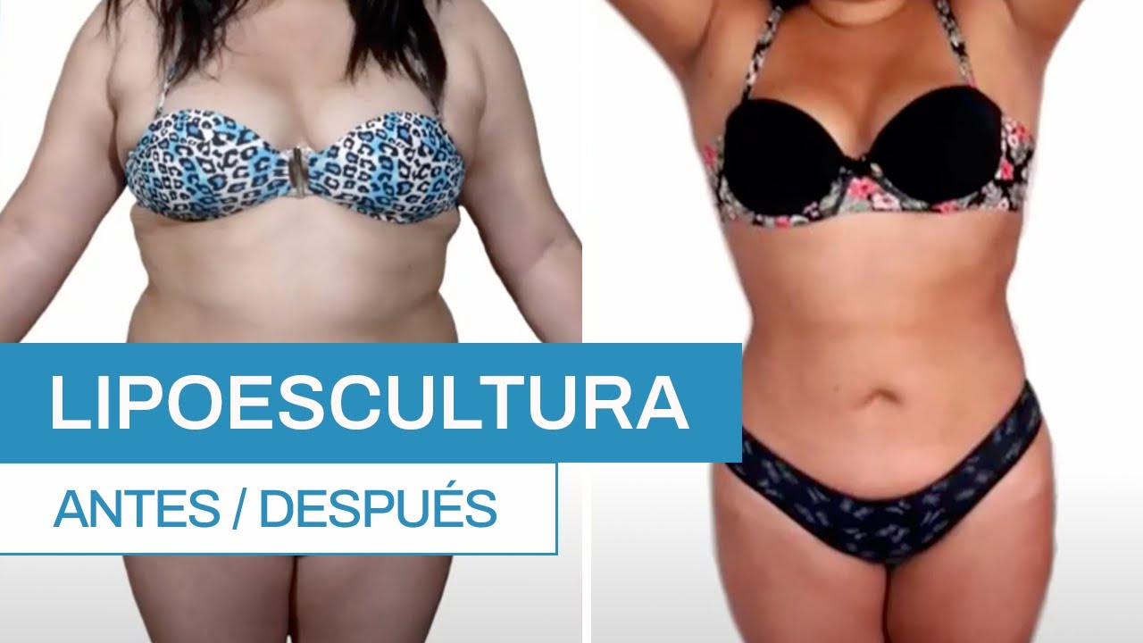 Watch ¿Cómo es una Lipoescultura Antes y despuĆ©s | ClĆnica Barrenechea Now ¿Cómo es una Lipoescultura Antes y despuĆ©s | ClĆnica Barrenechea