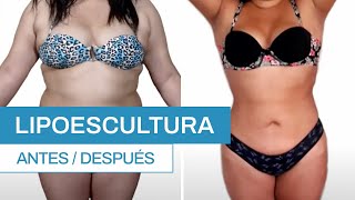 ¿Cómo es una Lipoescultura Antes y después | Clínica Barrenechea