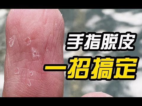 剝脱性角質鬆解症