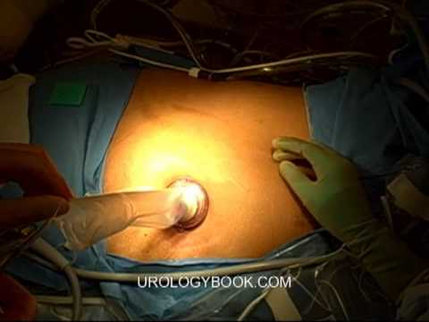 Single Site Surgery Insertion of Port 