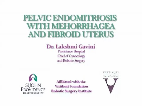 Pelvic Endomitriosis with Mehorrhagea and Fibroid Uterus