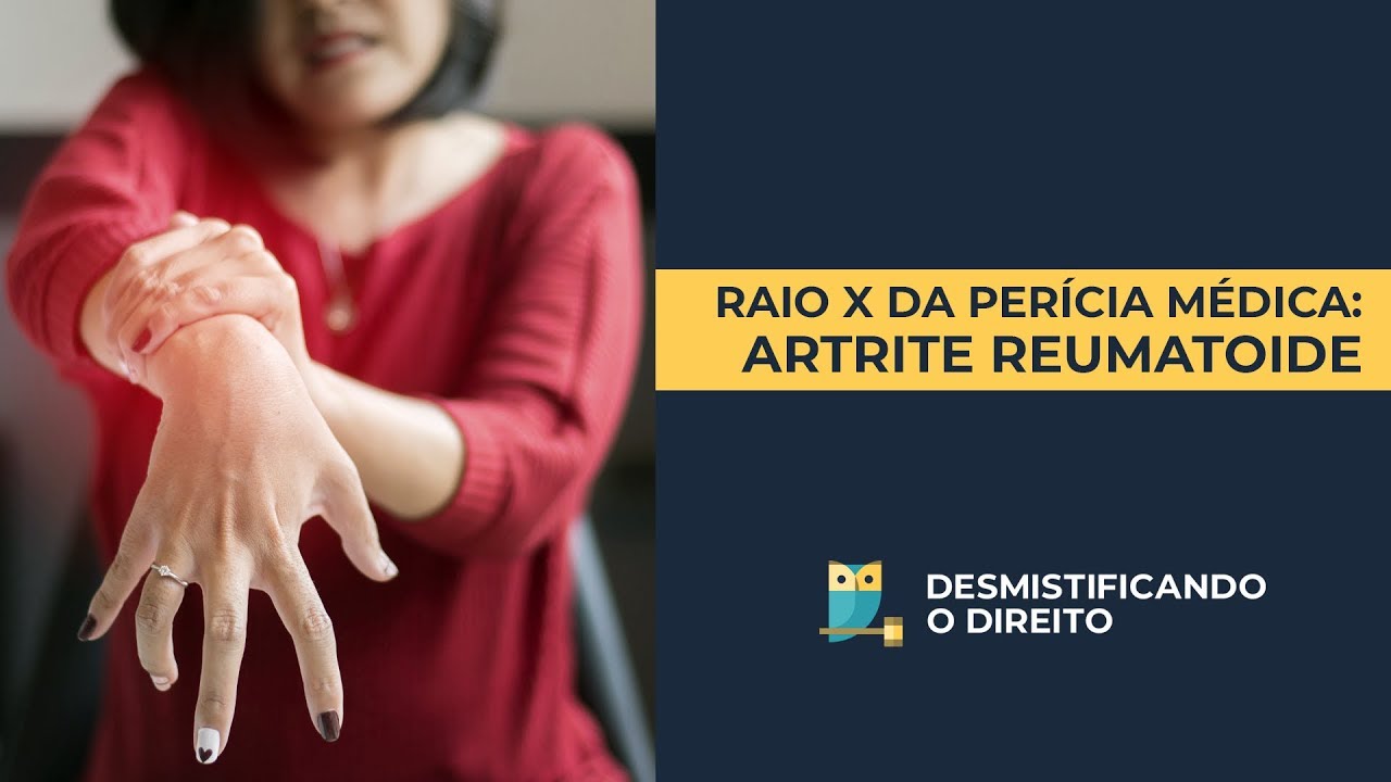 Desmistificando a Perícia Médica: Artrite Reumatoide