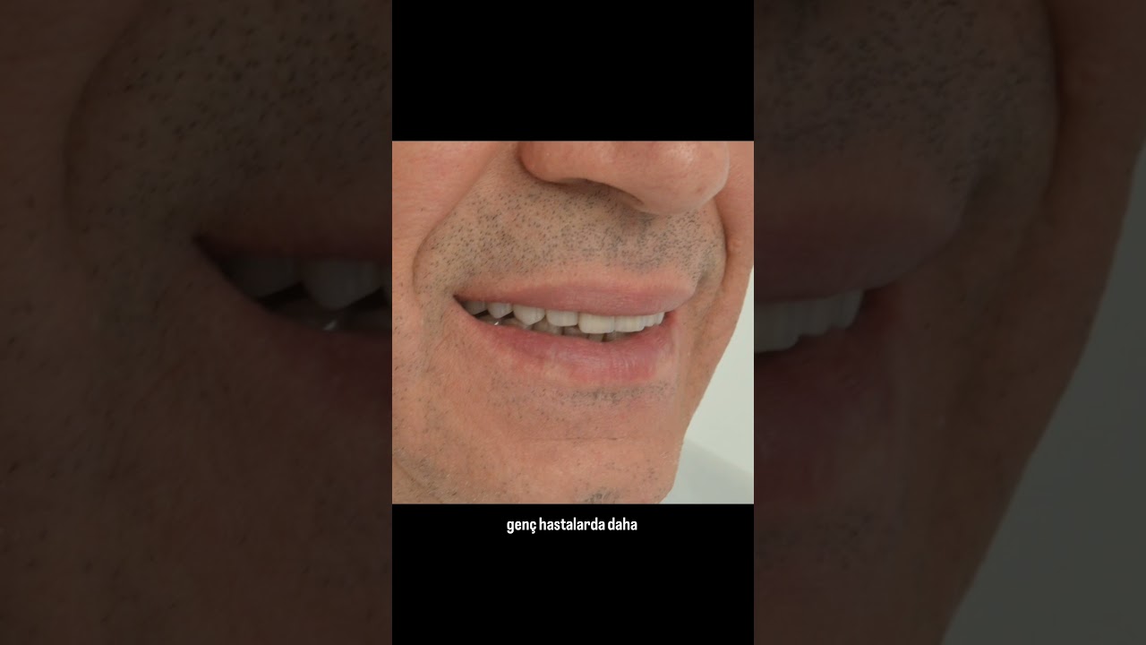 Incisal Line - 2