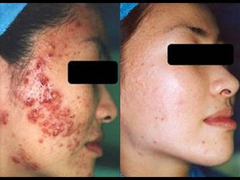 Kung paano haharapin ang mga batak balat pagkatapos pagbaba ng timbang Honey at kanela para sa mga benepisyo pagbaba ng timbang