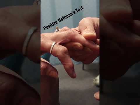 T1 Nerve Root Compression Evaluation with Paul Marquis PT