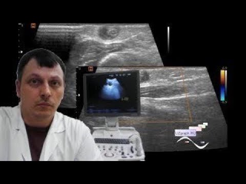 Pediatric Soft tissue ultrasound - Subcutaneous shoulder lesion