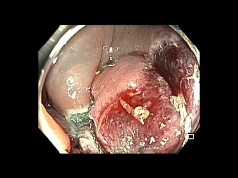 Colonoscopy: Transverse colon flat lesion - difficult resection