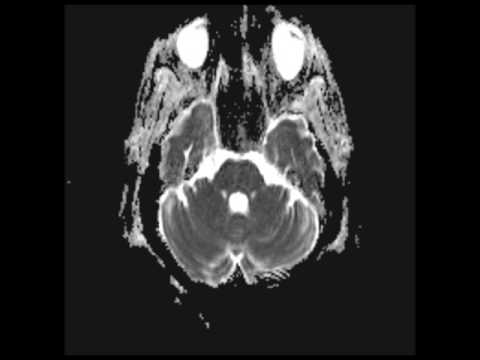 Persistent Trigeminal Artery