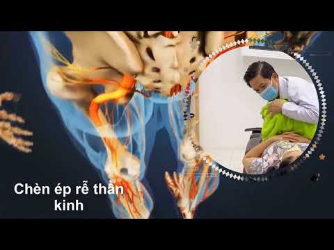 Điều trị Thoát vị đĩa đệm - Trượt đốt sống - Đau thần kinh tọa. Không dùng thuốc