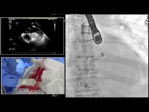 [AP VALVES & SH 2019] Live Case & Lecture 6: LAAO #10