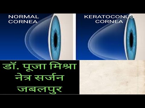 keratoconus, hogyan lehet vele helyreállítani a látást)