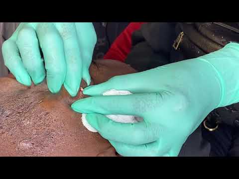Face Cyst Explosion