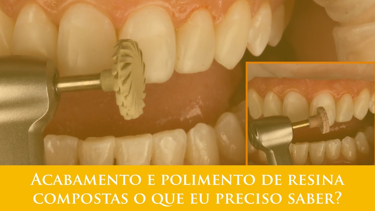 Acabamento e polimento de resina compostas o que eu preciso saber?