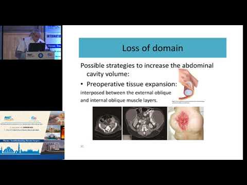 Pre-op optimisation in AWR: Doron Kopelman