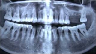 preview picture of video 'Lynnwood Dental X-rays - Dimayuga Family Dental'