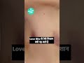 Have You Ever Wondered Why Hickeys Or Love Bites Leave Such Marks Shorts Health Live