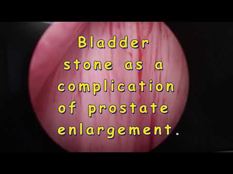 Bladder stone as a complication of prostate enlargement|Dr. SK.Palash