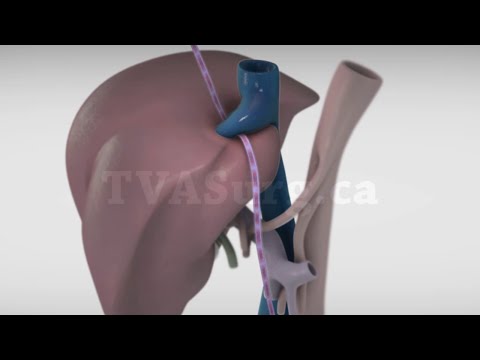 Standard left hepatectomy