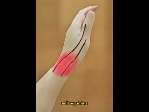 De Quervain's Tenosynovitis: Quick Fix in 5 Steps! #shorts