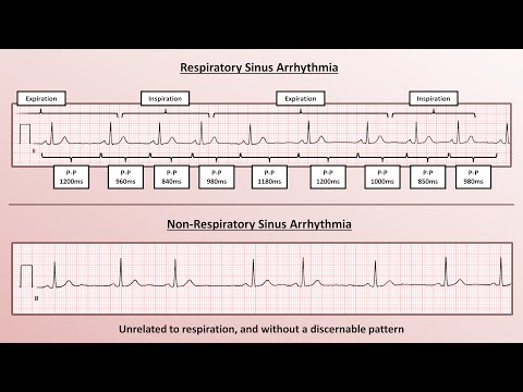 Advanced EKGs - Sinus Node Dysfunction